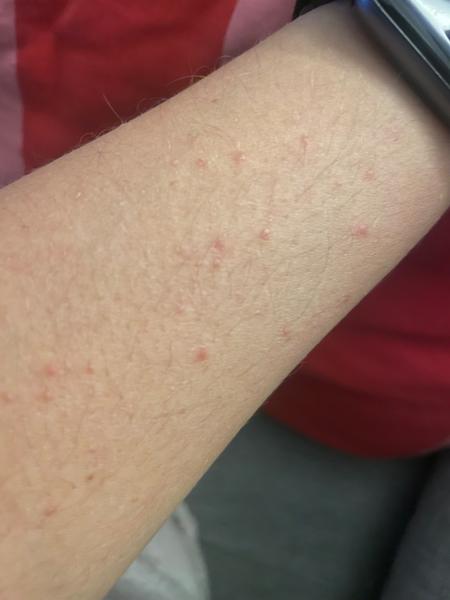 Jak rozpoznat a léčit svědivé červené pupínky?