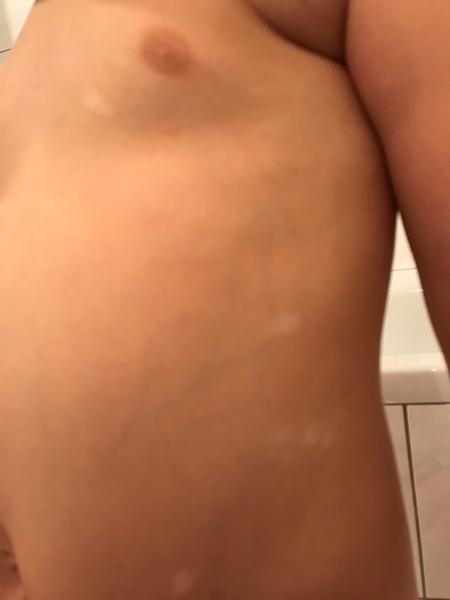 Skvrnky na kůži. Postupují dál. Setkaly jste se s tím?