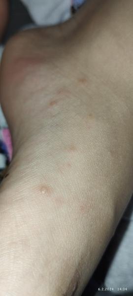 Puchýřková vyrážka u dítěte. Co to může být?