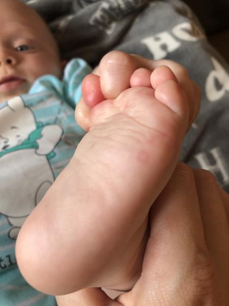 Fleky na těle u dítěte 5 let - jsou to potničky nebo něco jiného?