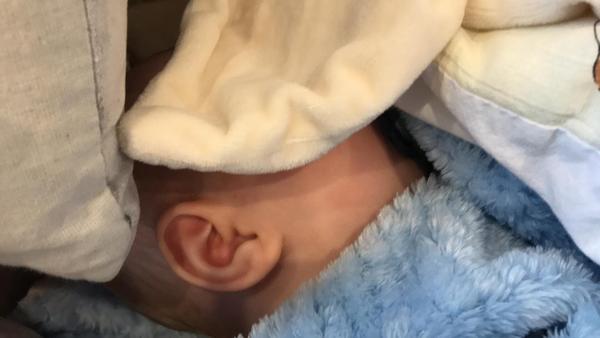 Ekzém či kvasinka?