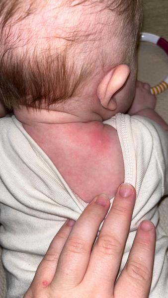 Červené fleky s bílým vnitřkem. Nemůže to mít souvislost s komplikacemi po porodu?