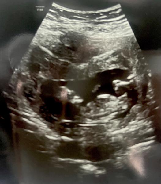 Pohlaví dítěte. Poznáte, prosím?