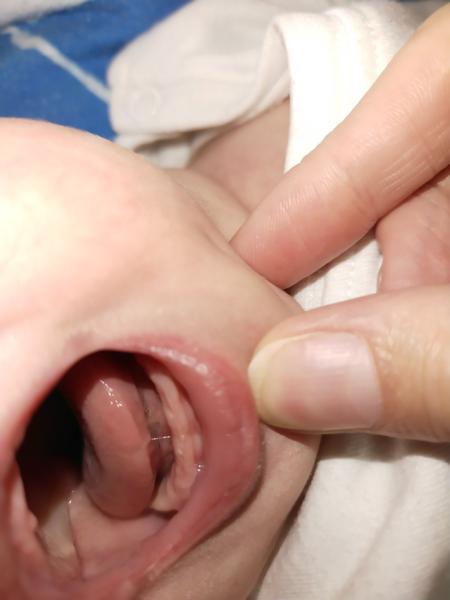 Mohou být příznaky vašeho dítěte způsobeny růstem zoubků?