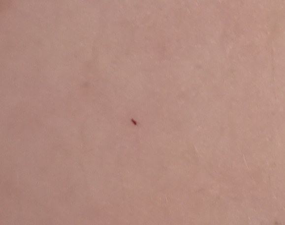 Štípanec. Od čeho by to mohlo být?