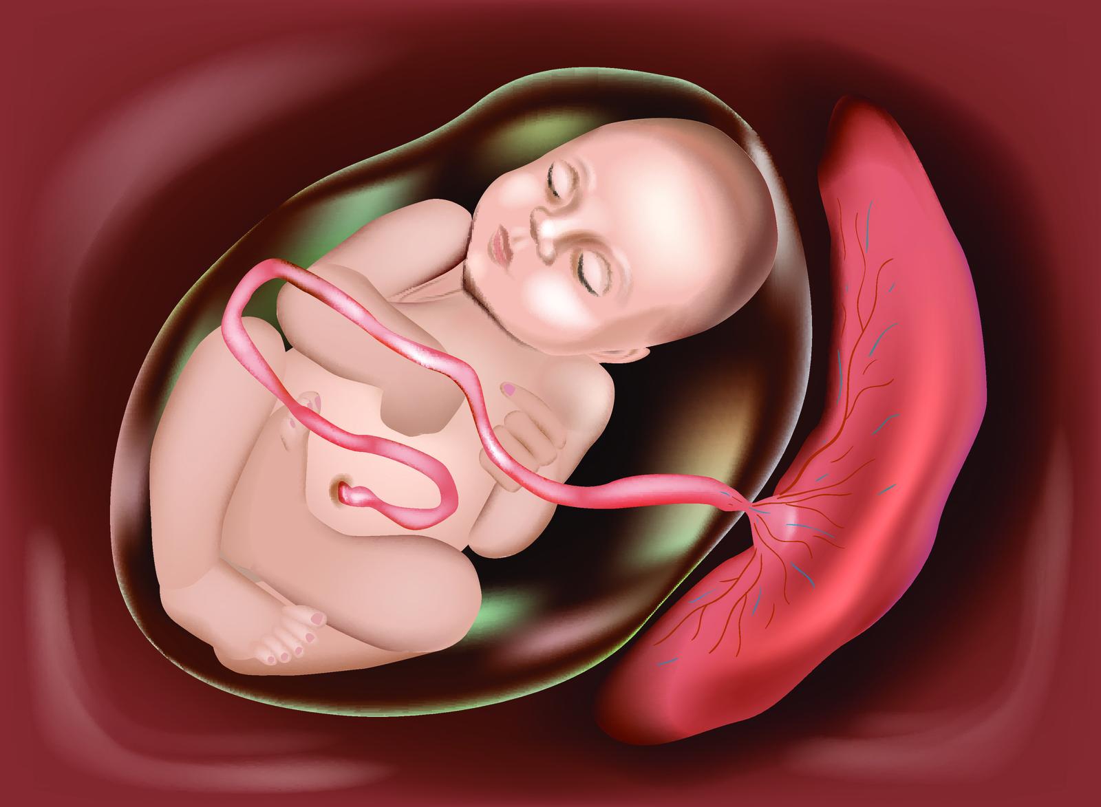 placenta praevia