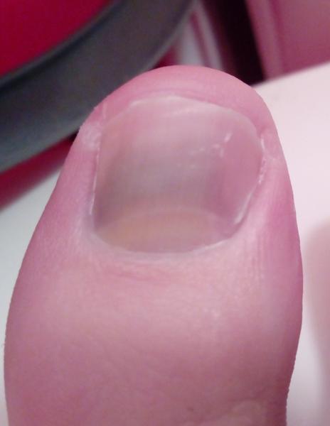 Nazelenalý, nažloutlý nehet na palci. Je to plíseň? Anebo co to může být?