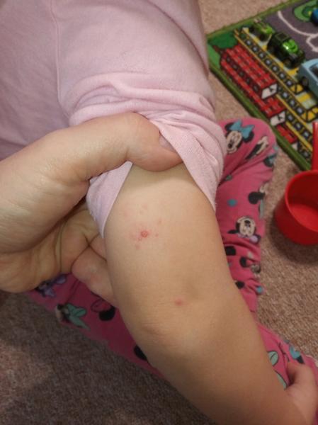 Jsou to neštovice? Co dělat?