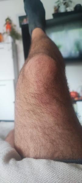 Červené ohraničení na noze. Co by to mohlo být?