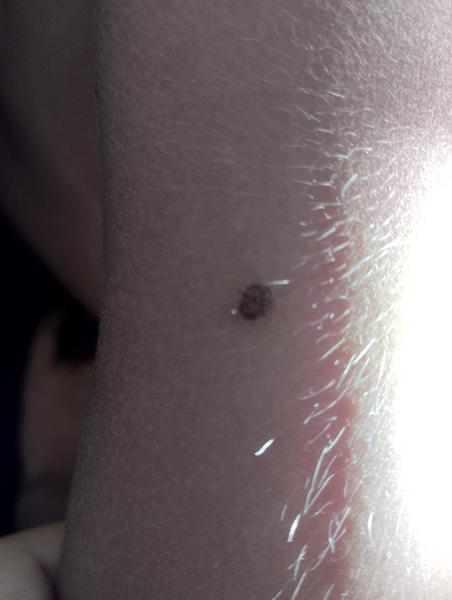 Vyříznout odtržené znaménko hned na pohotovosti?