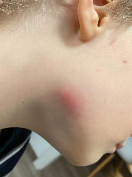 Nevysvětlitelné červené fleky u syna: Co dělat?