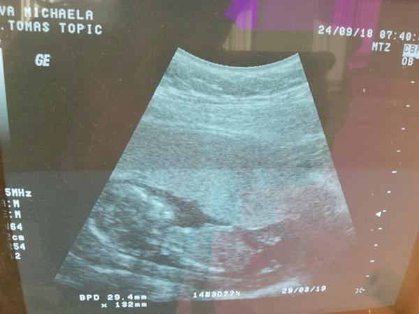 Pohlaví miminka - může to být kluk?