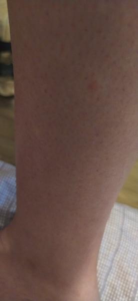 Je svědivý pupínek na noze příznakem něčeho vážného?