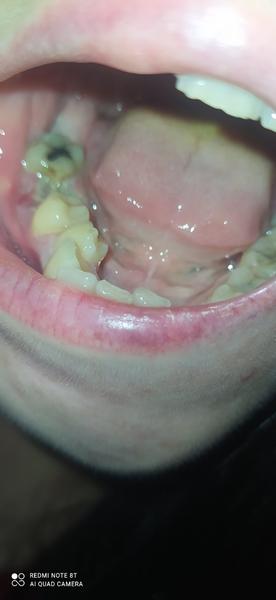 Co znamená šedivý povlak po extrakci zubu?