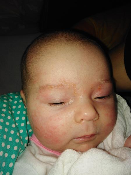Vyrážka v obličeji u šestitýdenní holčičky