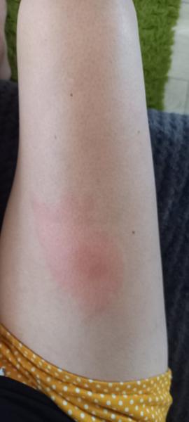 Reakce na vosí žihadlo. Je pulzování a bolest normální?