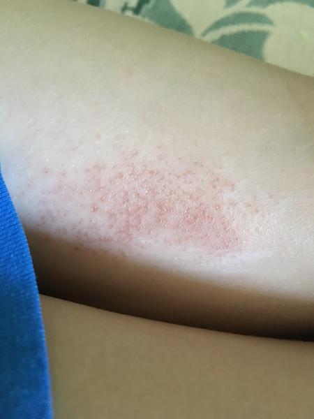 Může takto vypadat žahnutí od medúzy?