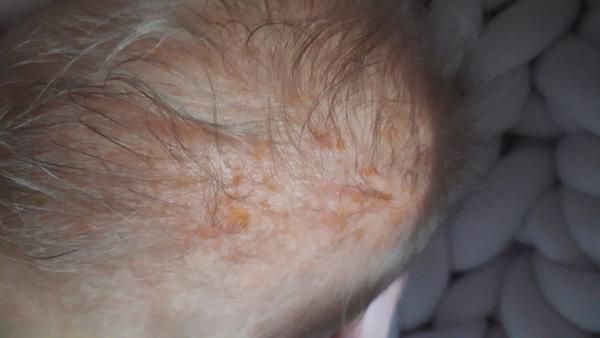 Vyrážka - žluté stroupky. Co s tím? Můžu mazat Sudocremem?