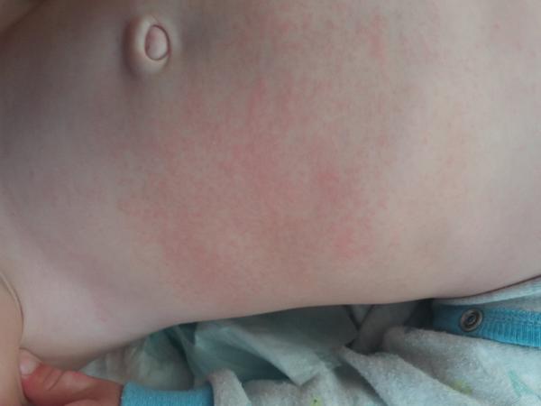 Vyrážka - "drsný" na dotyk a nesvědí