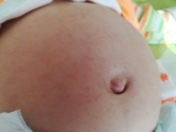 Vyráža u půlročního syna - co to může být?