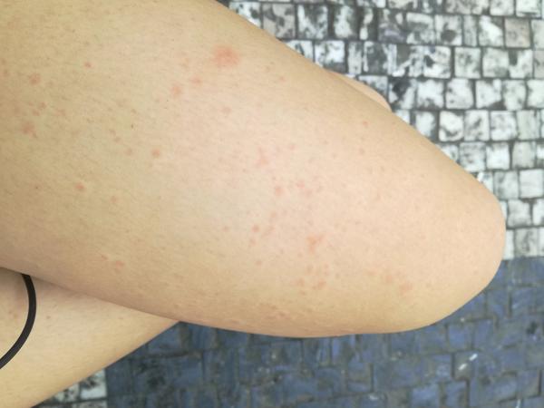 Jsou to neštovice nebo alergie?