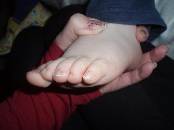 Stočené malíčky dovnitř, může za to špatná obuv?