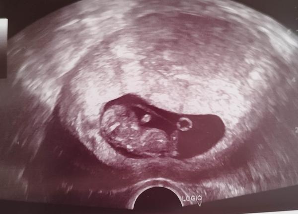 Lze poznat pohlaví miminka z ultrazvuku v prvním trimestru?