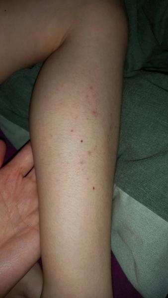 Fialové fleky u dítěte. Může jít o alergii?