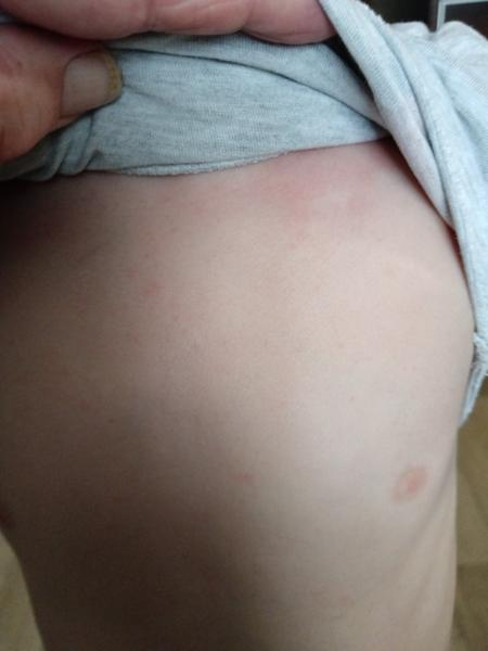 Co může znamenat podobná vyrážka u dítěte?