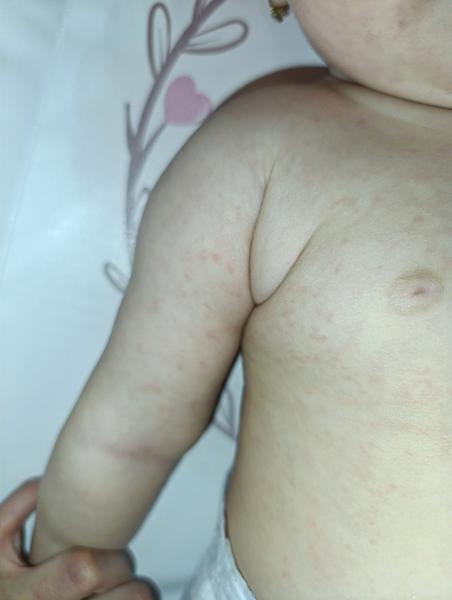 Vyrážka a nespaní u dcery. Jsou to zoubky?