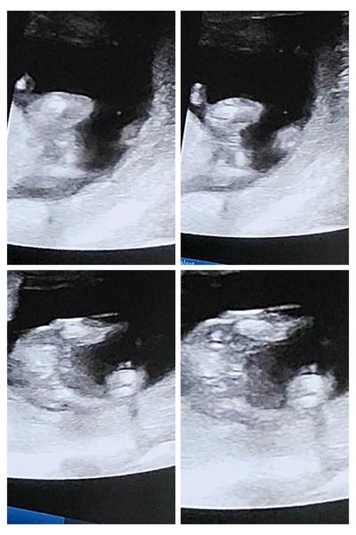 Ultrazvuk 16. týden: Jak poznat pohlaví dítěte?