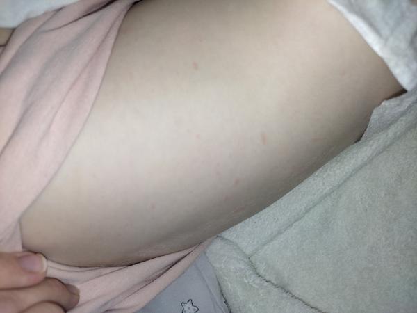 Fleky na těle u dítěte po horečce. Co to může být?