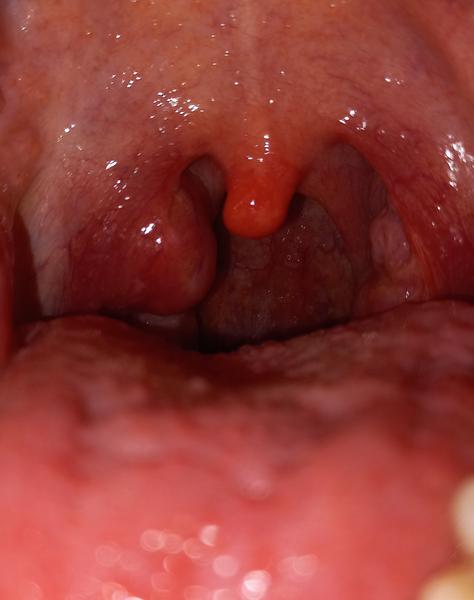 Jak léčit čepy v ústech bez bolesti?