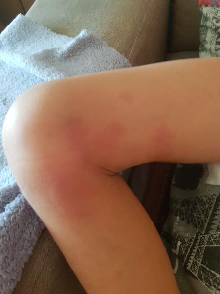 Nevíte, co je to za vyrážku u dítěte?