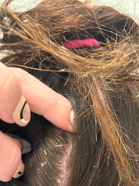 Šupinky na pokožce hlavy. Jak se jich zbavit?