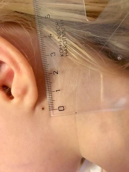 Piha. Je běžné, že se takto objevují? Mám to nějak řešit, resp., kdy jít na kožní?