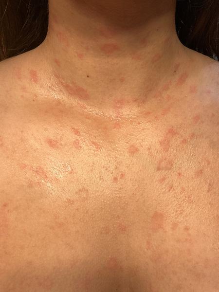 Neznámá vyrážka: Jaké jsou možné příčiny?