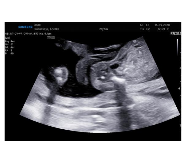 Určení pohlaví miminka, MUDr. Frisova, profema. Co myslíte vy?