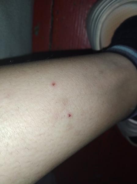 Svědění nohou: Jak rozeznat, zda je to svrab?