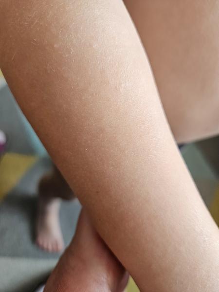 Krupičková vyrážka u dítěte. Mohla by to být alergie?