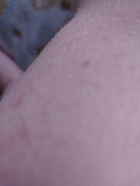 Vyrážka na ruce. Co by to mohlo být?