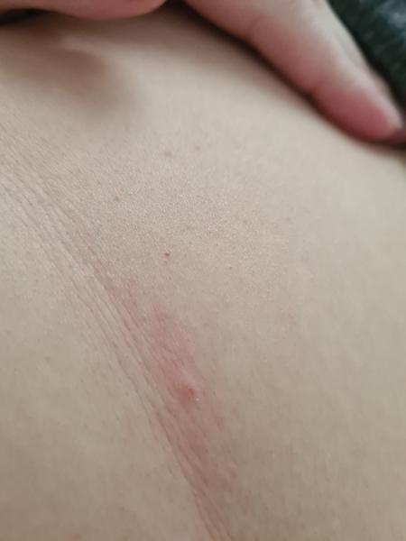 Svědivá vyrážka. Co to může být?