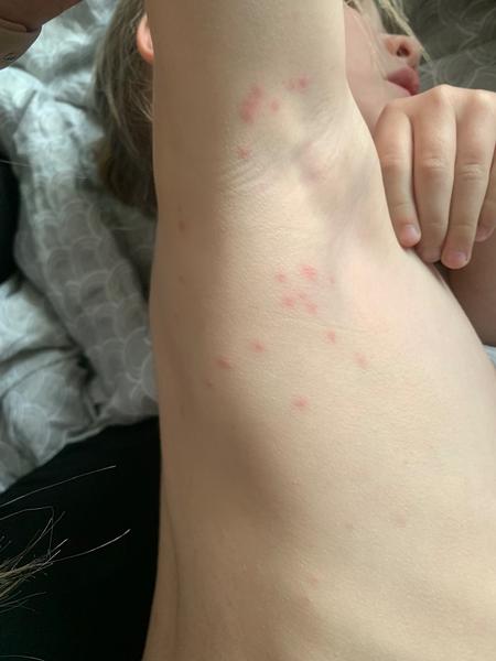 Jsou pupínky u dcery příznakem neštovic?