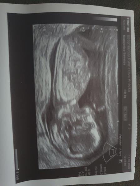 Fotka z prvního screeningu. Tipnete pohlaví miminka?