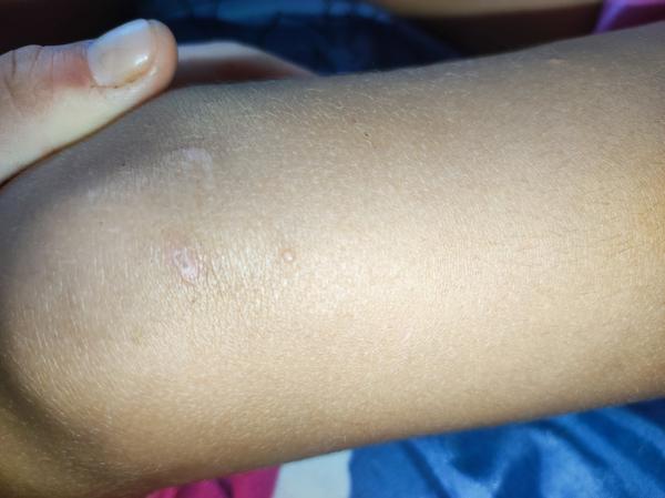 Mohou být pupínky na nožičkách dcery alergií?