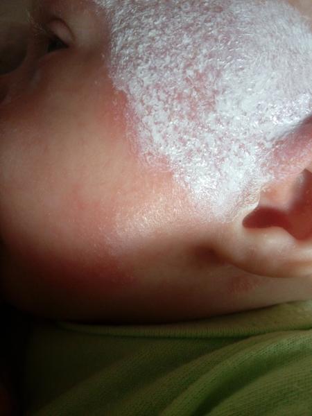 Ekzém u 4měsíčního miminka. Poradíte, prosím?