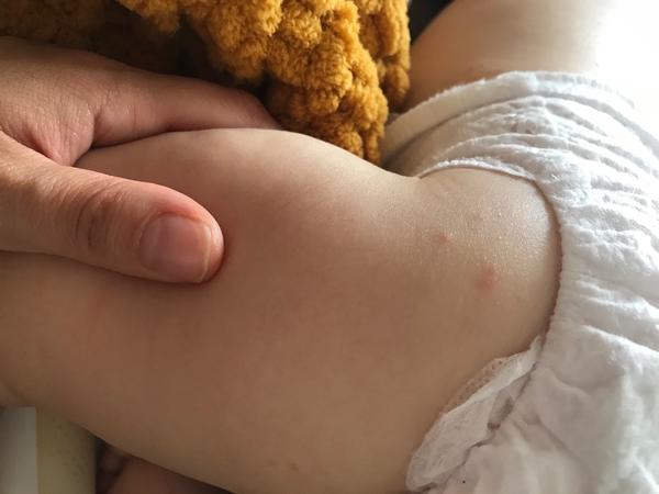 Vyrážka u ročního miminka. Co by to mohlo být?