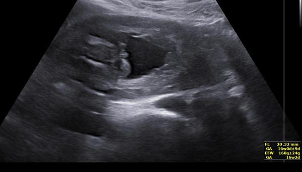 Pohlaví dle ultrazvuku mezi nožičkami. Pozná Vaše zkušenějši oko?