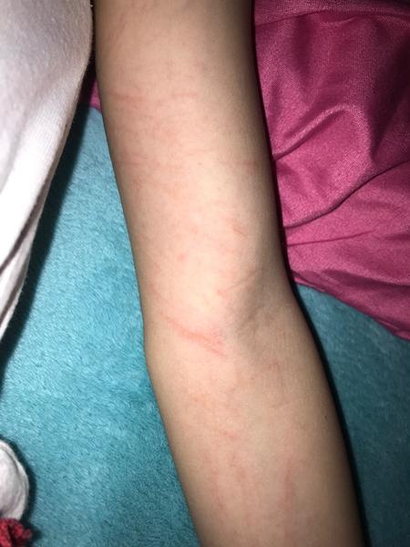 Co znamenají škrábance jako vyrážka na rukou?