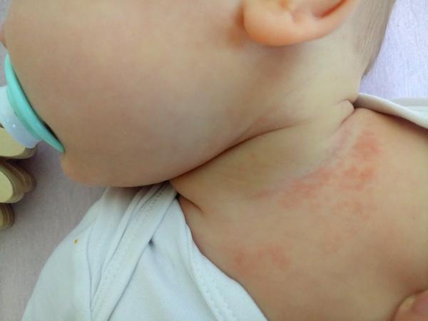 Poznáte prosím tuhle vyrážku?